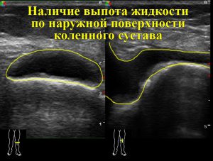 Наявність виппота рідини по зовнішній поверхні колінного суглоба